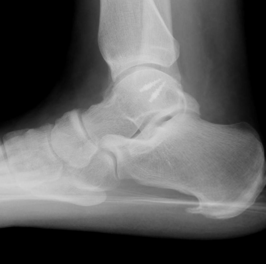 Ankle Lateral Ligament Reconstruction Lateral